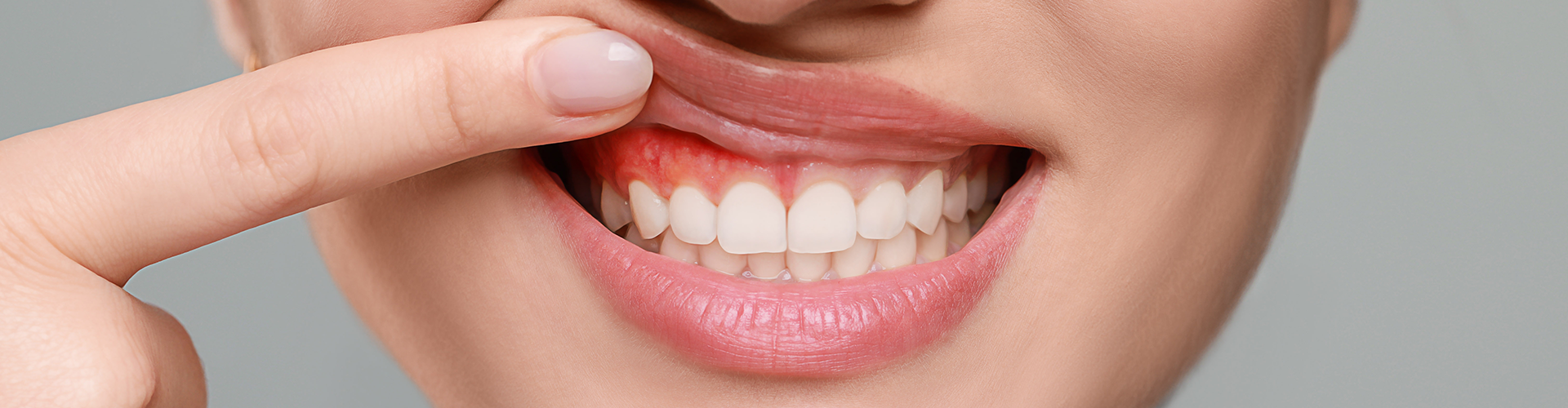 woman lifting upper lip to show inflamed gums